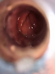 butthole tunnel plug